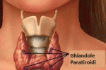 LE MALATTIE DELLE PARATIROIDI: L'IPERPARATIROIDISMO