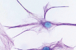 leggi tutto l'articolo Primo trapianto di cellule staminali cerebrali per combattere la Sla Primo trapianto di cellule staminali cerebrali per combattere la Sla