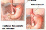 REFLUSSO GASTRO-ESOFAGEO