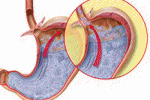 Reflusso neonato