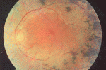 leggi tutto l'articolo Retinite pigmentosa Retinite pigmentosa