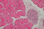 leggi tutto l'articolo Arteriosclerosi la cura dall'ormone Arteriosclerosi la cura dall'ormone