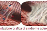 SINDROME ADERENZIALE