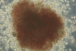 leggi tutto l'articolo HSCT: analisi retrospettiva del risultato di trapianti correlati vs non correlati HSCT: analisi retrospettiva del risultato di trapianti correlati vs non correlati