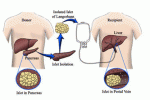 Infusione di cellule staminali ematopoietiche nei pazienti con insufficienza epatica