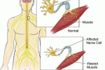 Plasma derivato dal sangue cordonale: effetti su cellule mononucleate di pazienti con SLA