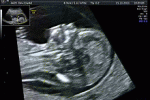 leggi tutto l'articolo Sindrome Down, ecco il test prenatale Sindrome Down, ecco il test prenatale