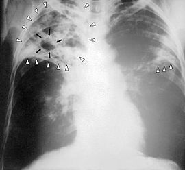 immagine ad i raggi x in cui si evidenzia presenza tubercolosi