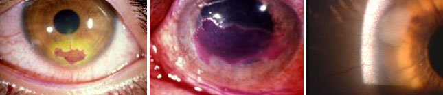 ulcere-corneali-rosso-trasparenza