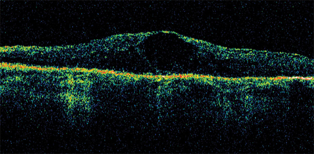 vitreo-microscopio