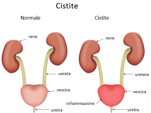 cistite infiammazione