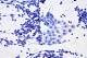 Tumori: nanoparticelle per distruggere le metastasi - Retrò Online