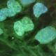 Cellule staminali del midollo per combattere la sclerosi multipla - Wired.it