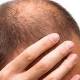 Calvizie: lo strappo selettivo per far ricrescere i capelli - Velvet News Italia