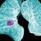Cancro al polmone, nuove speranze grazie al mir-Test - Emerge il Futuro