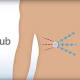 Diabete, primo trapianto tech di cellule pancreatiche - TGCOM