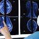 Tumore seno, scoperta proteina che predice risposta a terapia - ANSA.it