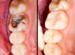 cura del dente permanente con materiale composito