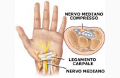 La sindrome del tunnel carpale
