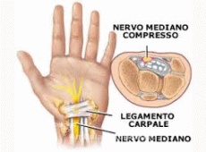 La sindrome del tunnel carpale