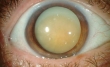 La cataratta è una opacizzazione della lente che si trova all'interno dell'occhio. Questa lente prende il nome di cristallino. Il cristallino è composto principalmente da acqua e proteine. Con il tempo, le proteine possono ossidarsi, offuscando la luce ch