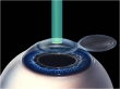 Intervento laser (tecnica LASIK) per la correzione dei difetti refrattivi come la miopia,l'astigmatismo e l'ipermetropia