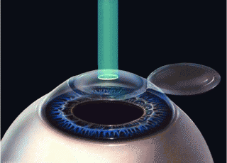 Intervento laser (tecnica LASIK) per la correzione dei difetti refrattivi come la miopia,l'astigmatismo e l'ipermetropia