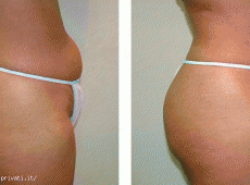 Trattamento della cellulite, adiposità localizzata, lassità cutanea.