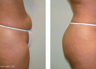 Trattamento della cellulite, adiposità localizzata, lassità cutanea.
